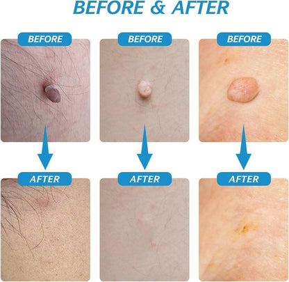 2-in-1 Skin Tag Remover Kit – The Painless Solution